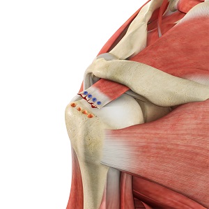 Recovery Tips for Rotator Cuff Injuries - AIRROSTI